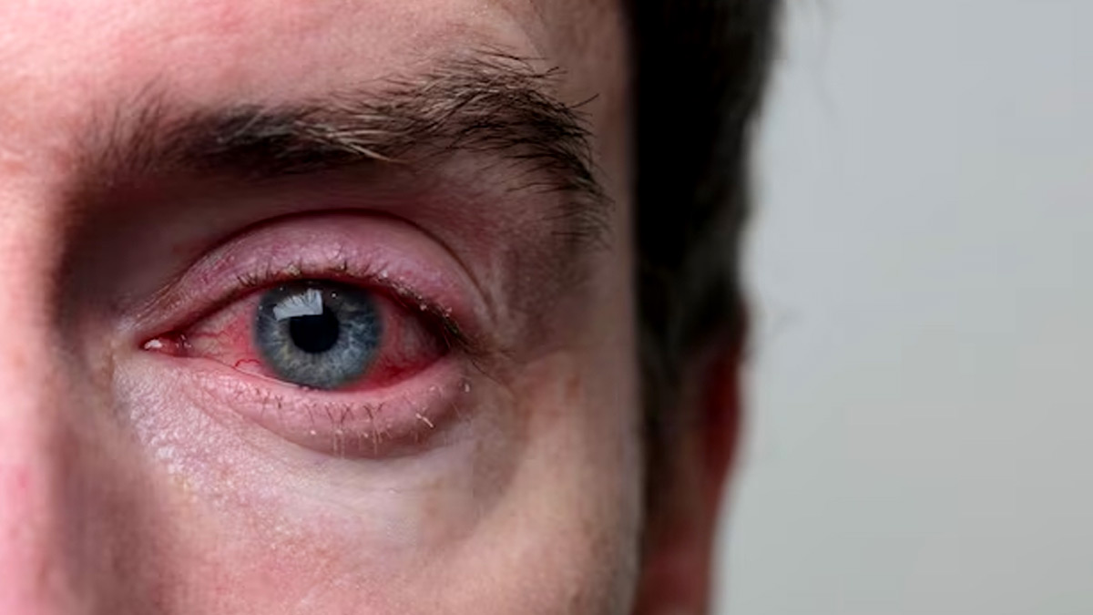 Pink Eye Infection : பிங்க் ஐ தொற்று கேள்விப்பட்டதுண்டா? அறிகுறிகள் எப்படி இருக்கும்? வராமல் தடுப்பது எப்படி?