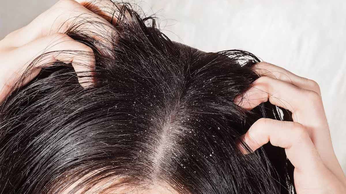 Combat Monsoon Dandruff: Effective Tips For A Flaky-Free Scalp